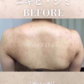 神戸元町　背中ニキビ、まだ諦めないで！薄着の季節までに美背中を手に入れる方法の画像