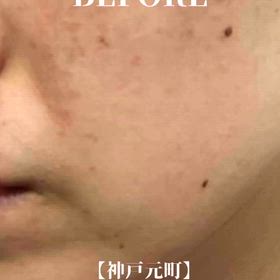 神戸元町/迷走した私が最後に選んだ「本気の肌改善プログラムの画像
