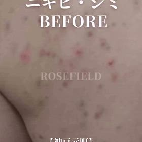神戸元町/背中ニキビ・シミ改善例の画像