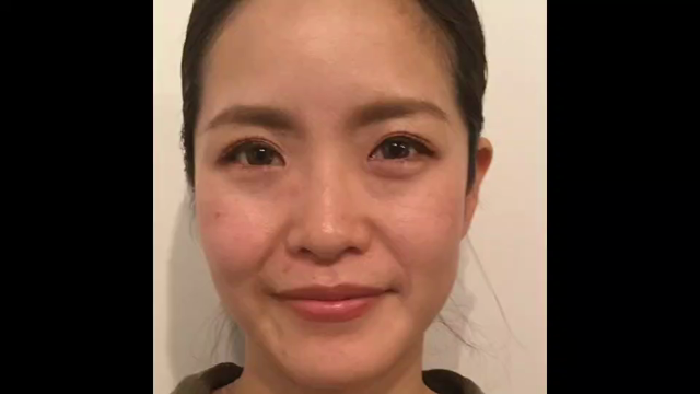 【動画あり！！】「隆鼻+輪郭矯正」40分10回コース　ビフォーアフターの記事動画