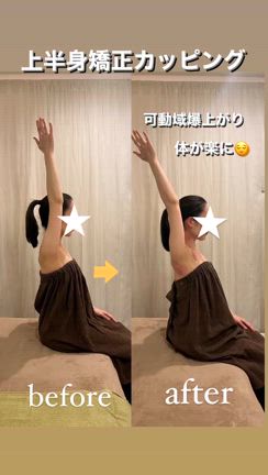 新技術！上半身矯正カッピングの記事動画