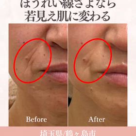 気になるほうれい線がの画像