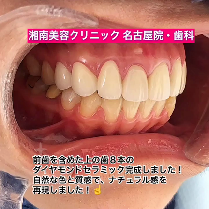 ８本ダイヤモンドセラミック完成！の記事動画