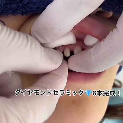 ダイヤモンドセラミック6本装着♪の記事動画