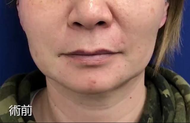 【バッカルファット】術後1週間の経過です【小顔】の記事動画