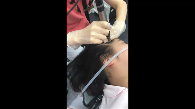 【クイックメソ】ダイレクトに頭皮に浸透！【薄毛治療】の記事動画