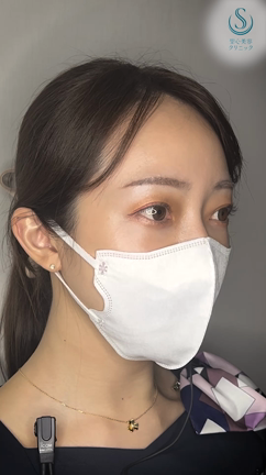 『二重全切開 』綺麗な平行二重に♡ （術後6ヶ月）の記事動画