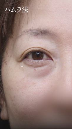 【ハムラ法】  手術内容と手術効果を動画で解説しました！の記事動画