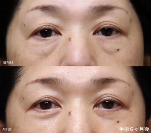 【ハムラ法】  50代女性・目の下をしっかり持続的に若返り！　 (術後６ヶ月）の記事動画