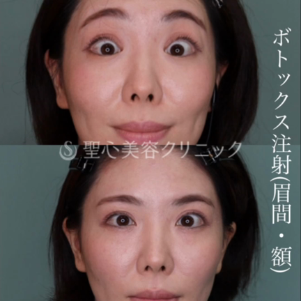 額・眉間ボトックス　動画の記事動画
