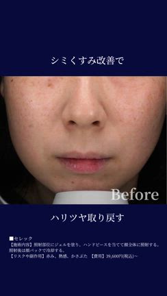 治療中とばれたくない方のためのシミ・くすみケアの記事動画