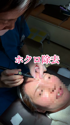 スタッフがホクロ除去をやってみた。の記事動画