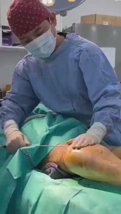 ソジン【ふくらはぎ脂肪吸引+ベロディー２レーザー】の記事動画