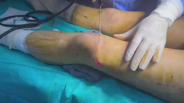 ソジン【ふくらはぎ脂肪吸引+ベロディー２レーザー】の記事動画