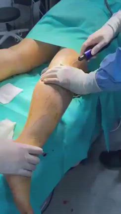 ソジン【ふくらはぎ脂肪吸引+ベロディー２レーザー】の記事動画