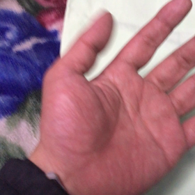 左手のリハビリの画像