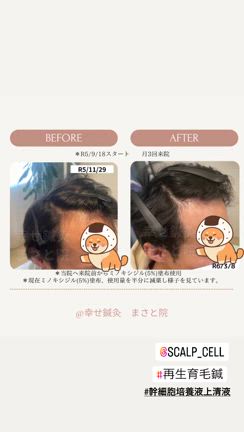 薄毛治療開始から半年経過の記事動画