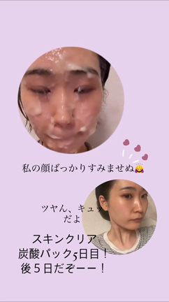 炭酸パック5日目！！明らかに目が大きくなった！の記事動画