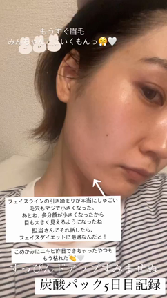炭酸パック5日目！！明らかに目が大きくなった！の記事動画