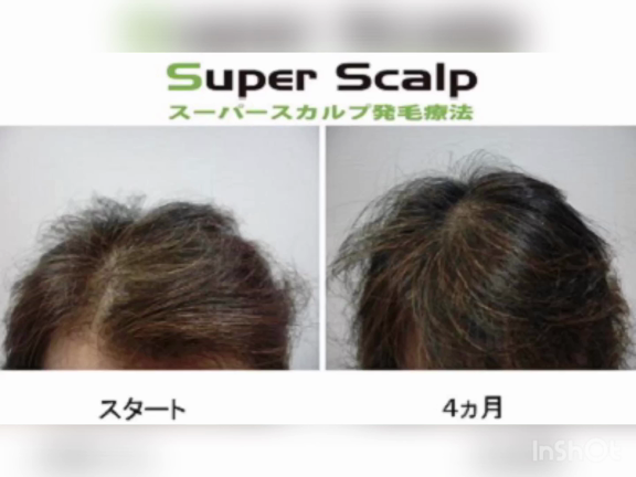 女性の薄毛改善の実績と症例の記事動画