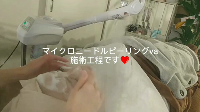 ニードルピーリングVAでニキビ跡、ニキビが改善♡の記事動画