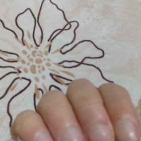 バネ指手術から1週間の画像