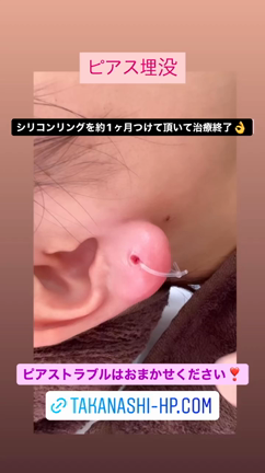 ピアストラブルはお任せください^_^の記事動画
