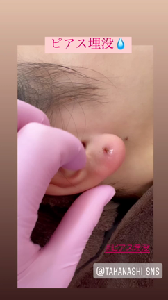 ピアストラブルはお任せください^_^の記事動画
