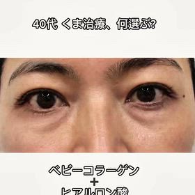 40代　くま治療、何選ぶ？の画像