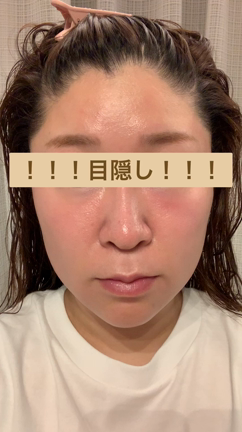 目指せ！ハリウッド女優肌～大阪･心斎橋・ツツイ美容外科～の記事動画