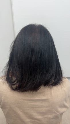 頭部の広範囲な傷跡植毛2回の手術で劇的に改善の記事動画
