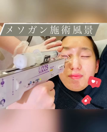 メソガン施術風景〜大阪・心斎橋・梅田・WCLINC〜の記事動画