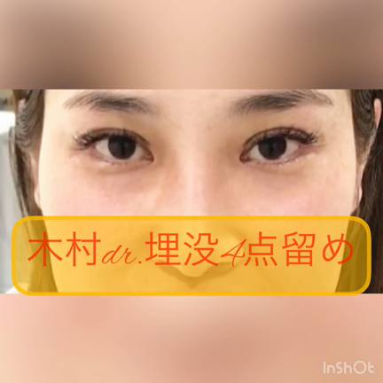 木村dr.による埋没4点留め〜大阪・心斎橋・梅田・Wクリニック〜の記事動画