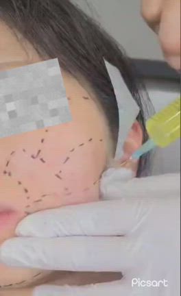 脂肪破壊術ダウンタイムはどのくらい❓の記事動画