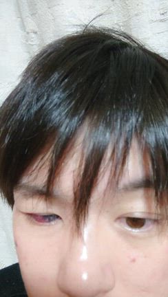 兎眼性角膜炎手術の記事動画