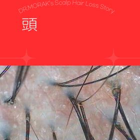 頭皮の血管が拡張する理由の画像
