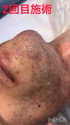 2回目のお客さま・死んだ毛が飛び出てきます！の記事動画