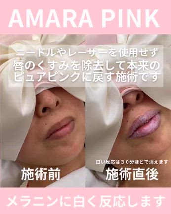 唇の縁は、メラニンが多くくすみが目立ちやすい部分ですの記事動画